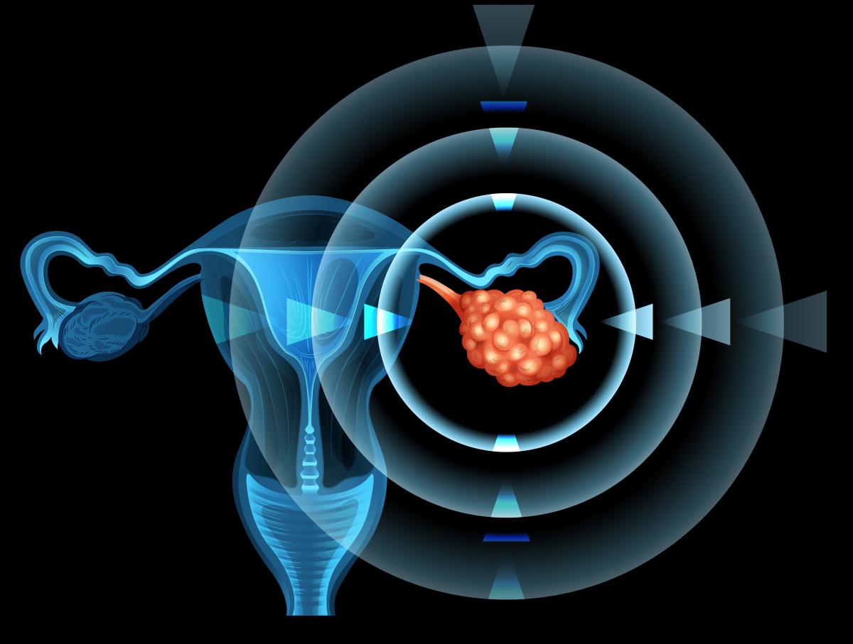 Лечение рака яичников за рубежом. Высокая эффективность лечения онкологии женской репродуктивной системы в Германии 