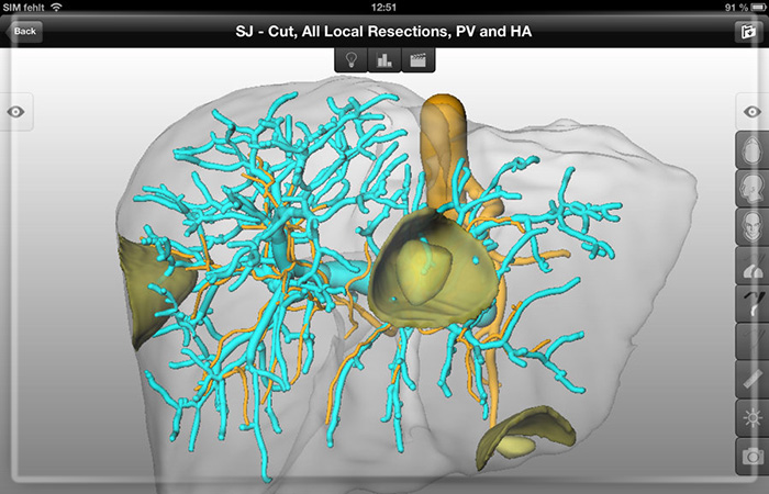 Лечение рака печени в Германии: как оперируют пациентов за рубежом Лечение рака печени в Германии: как оперируют пациентов за рубежом