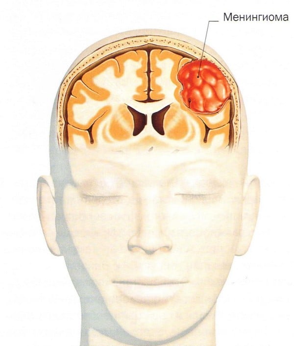 Доброкачественная опухоль головного мозга: отличия от рака, симптомы,  диагностика и лечение