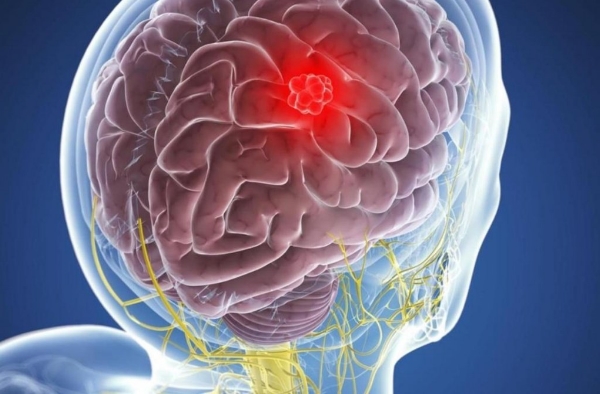 Стадии рака головного мозга: симптомы, диагностика, лечение, фото