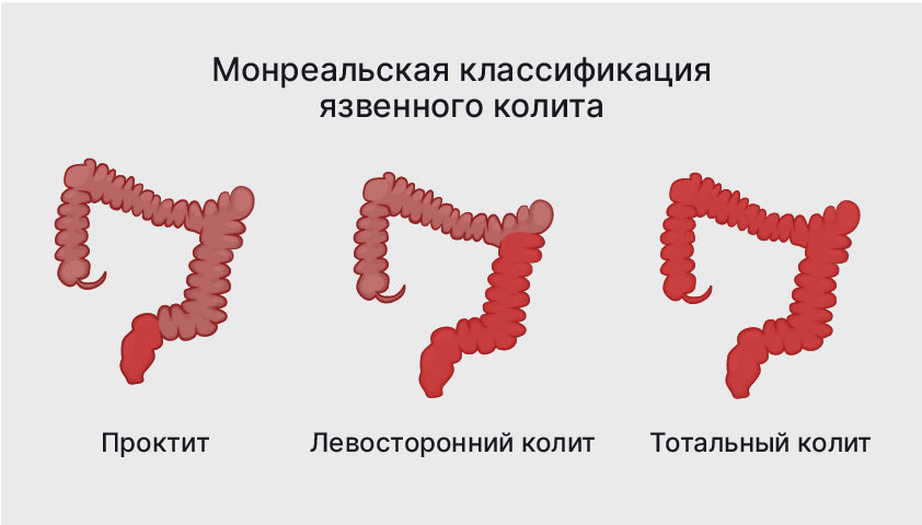 Лечение хронического воспаления кишечника: операции при сложном колите